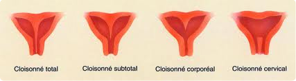 Qu’est ce qu’une cloison utérine ?