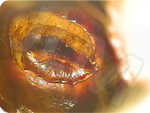 Photo  résection de la lésion sur le col de l’utérus