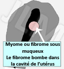 Fibrome / Myome