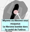 Les fibromes ou myomes