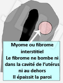 Les fibromes ou myomes