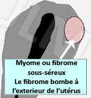 Les fibromes ou myomes