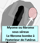 Fibrome / Myome